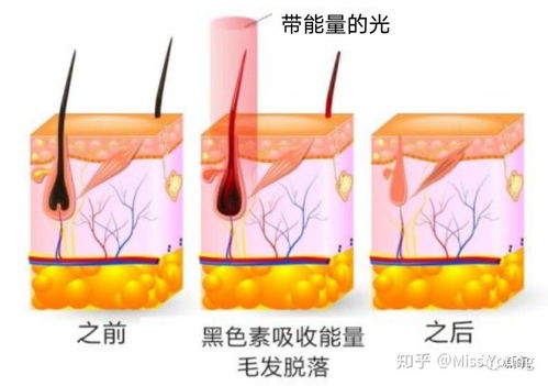 焕现丝滑肌肤｜荣获设计大奖的红光强脉冲脱毛仪使用推荐